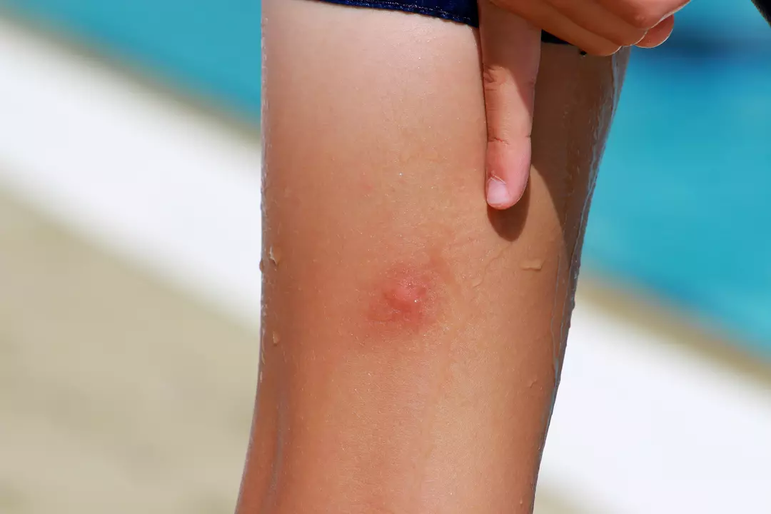 Comment soulager les fameuses piqûres de moustiques?